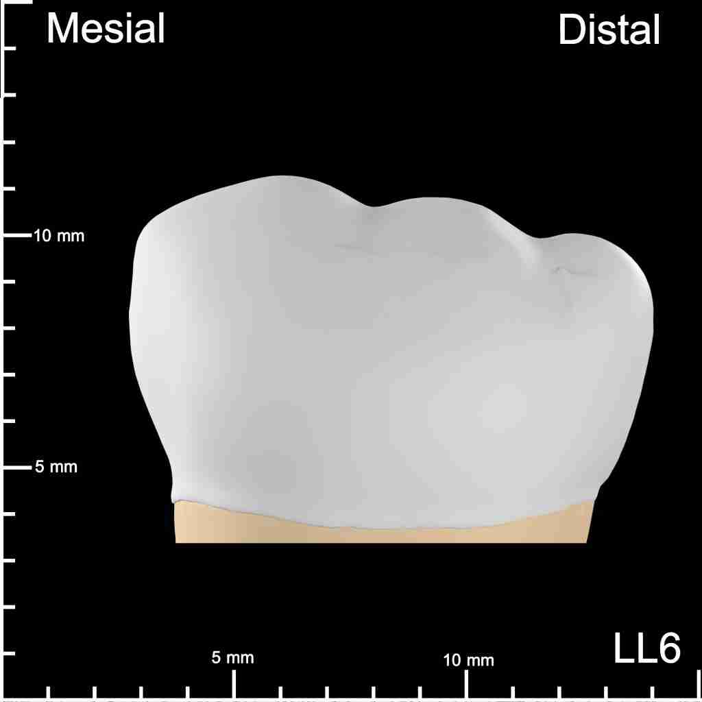 LL6 Deep Occlusal Mesiodistal
