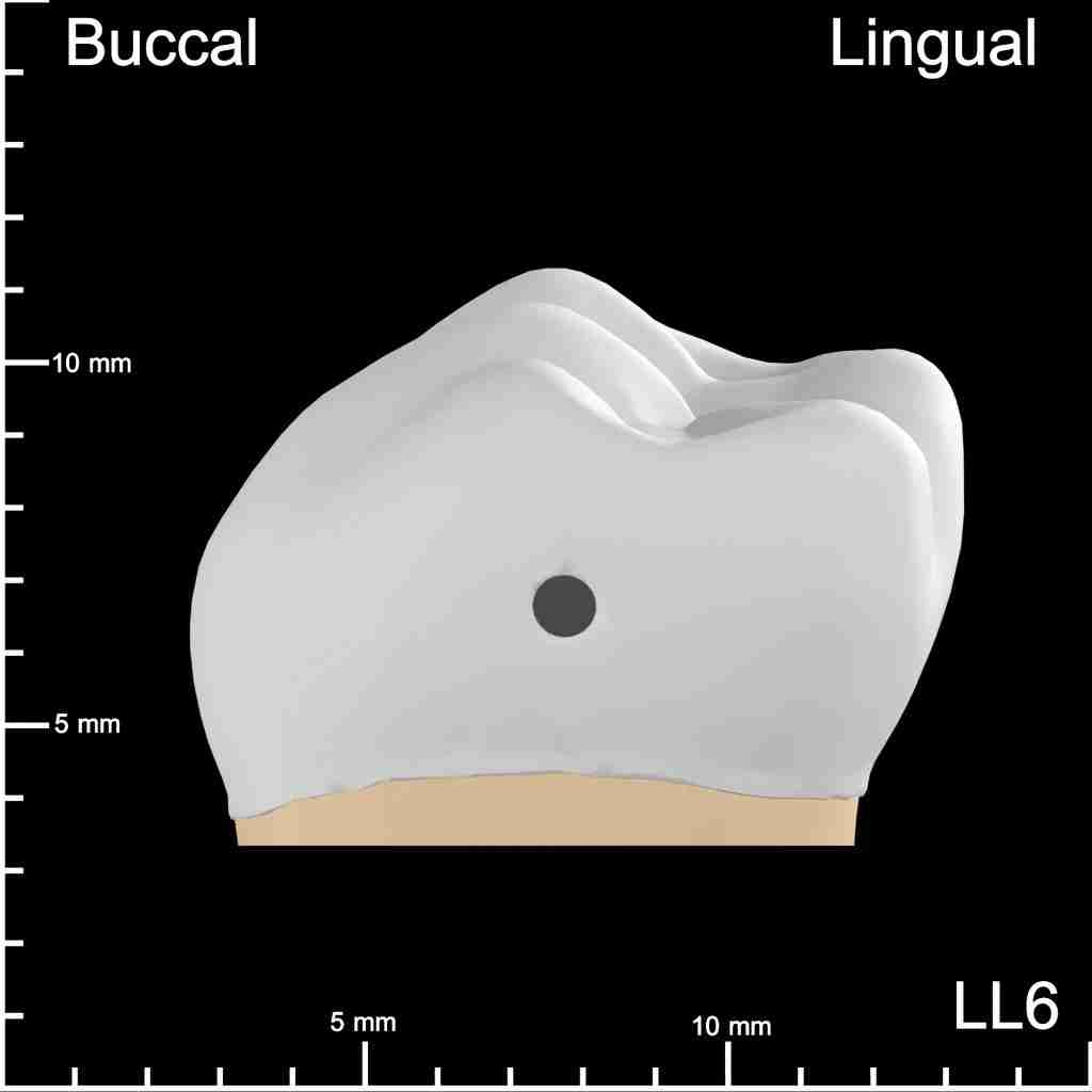 LL6 Distal Buccolingual