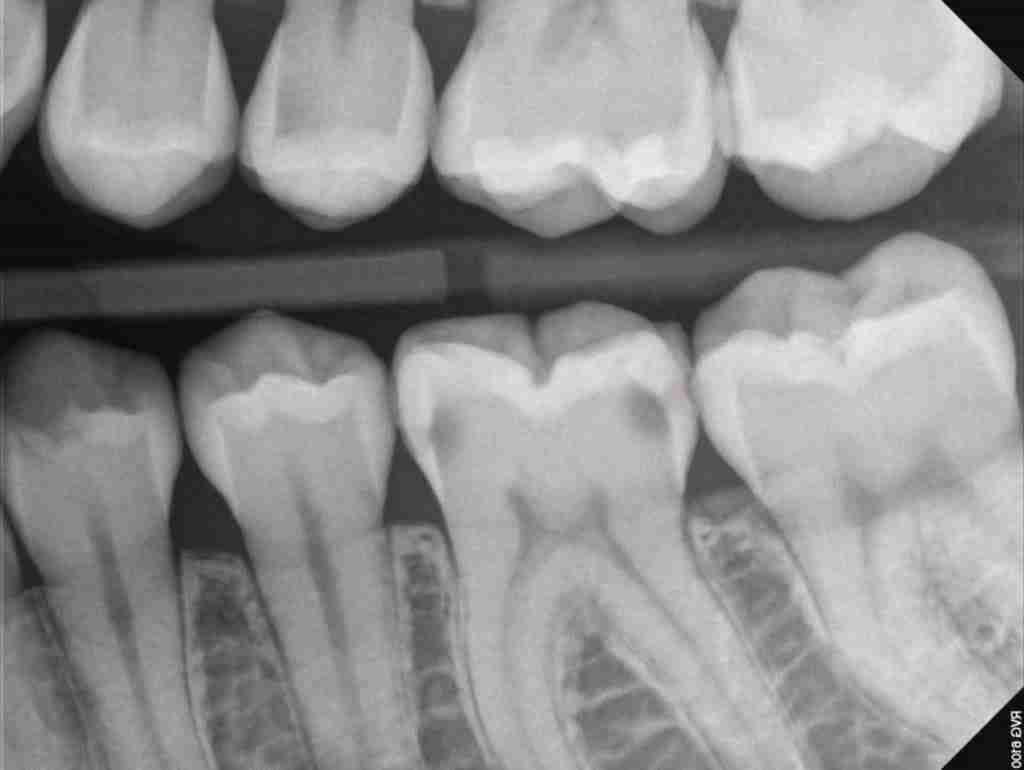 LL6 Distal and Mesial Radiograph