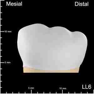 LL6 Distal and Occlusal Mesiodistal