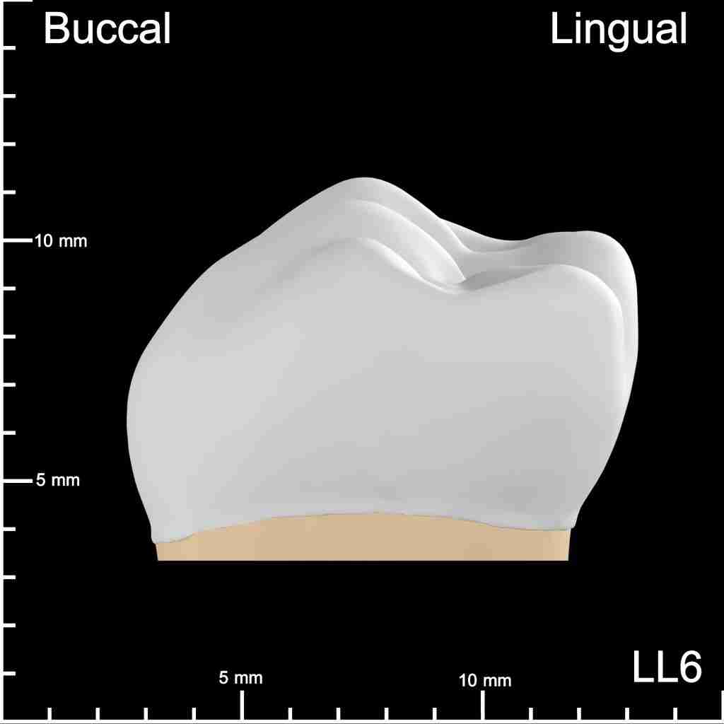 LL6 Mesial Buccolingual