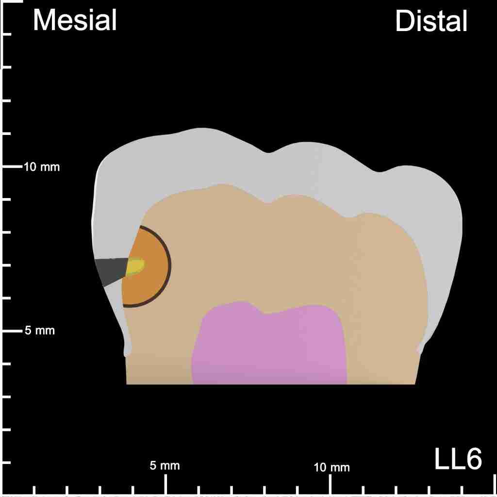 LL6 Mesial Mesiodistal Cutaway