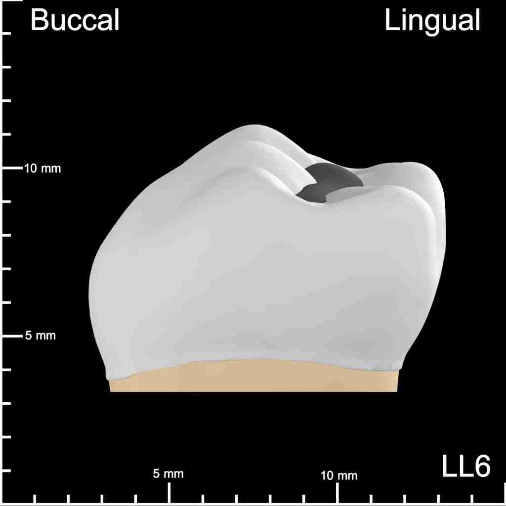 LL6 Mesial and Occlusal Buccolingual