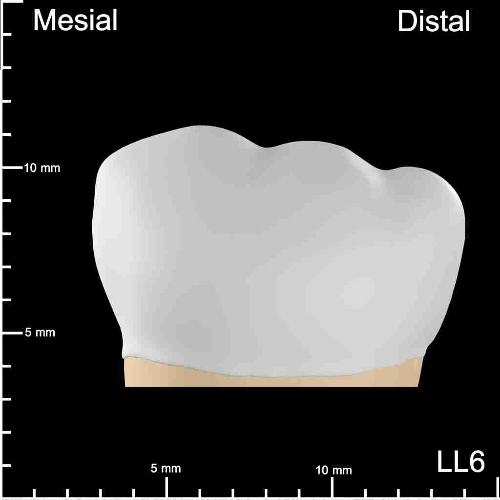 LL6 Mesial and Occlusal Mesiodistal