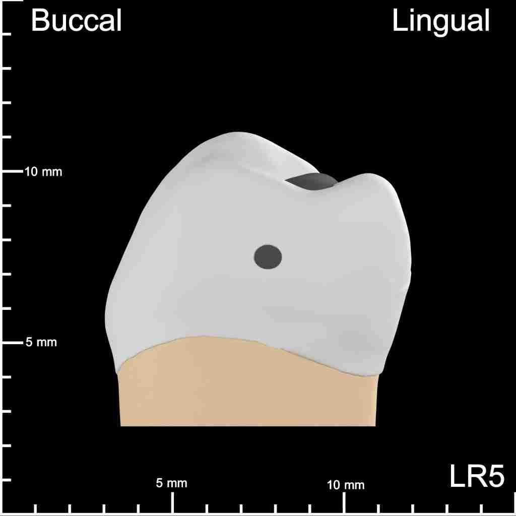 LR5 Mesial and Occlusal Buccolingual