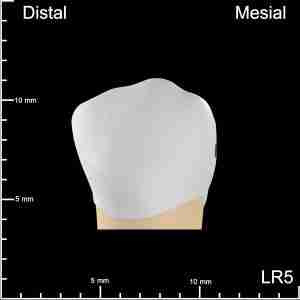 LR5 Mesial and Occlusal Mesiodistal