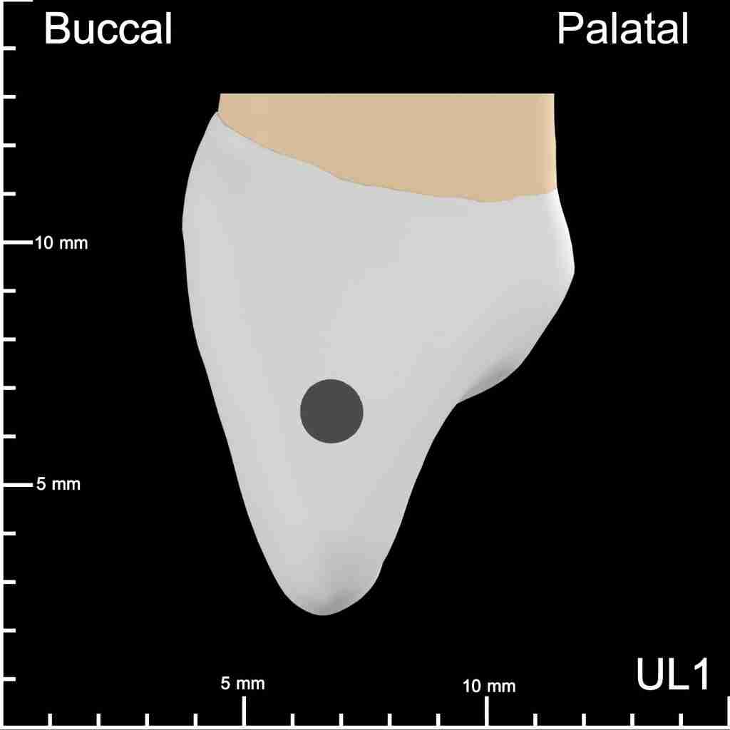 UL1 Mesial and Distal Buccopalatal