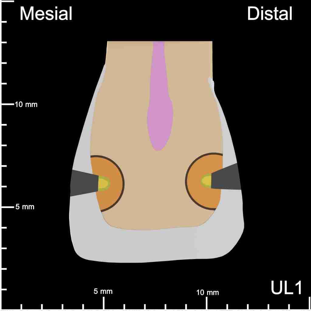 UL1 Mesial and Distal Mesiodistal Cutaway