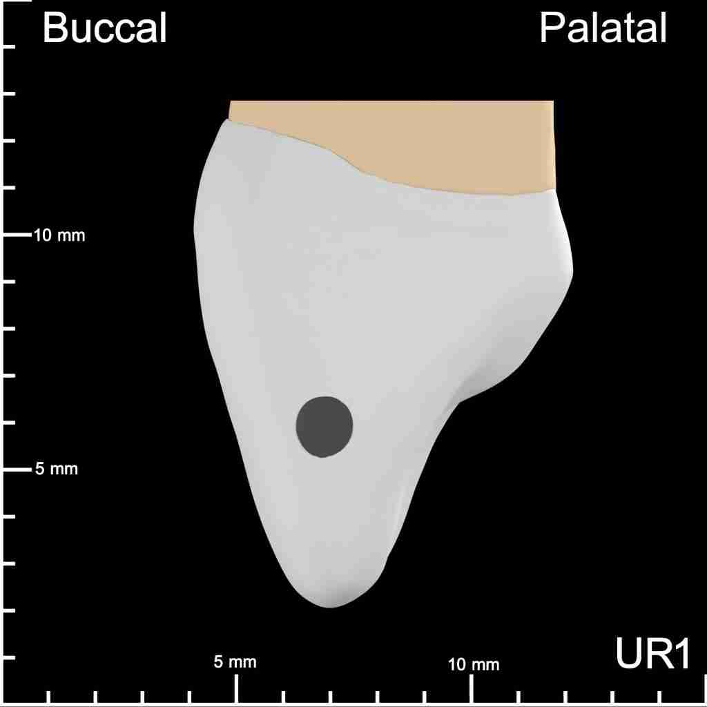 UR1 Mesial Buccopalatal