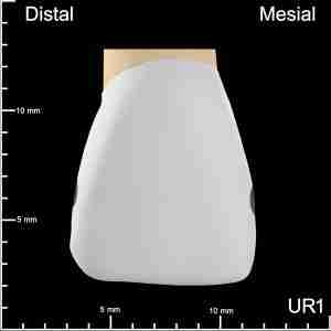 UR1 Mesial and Distal Mesiodistal