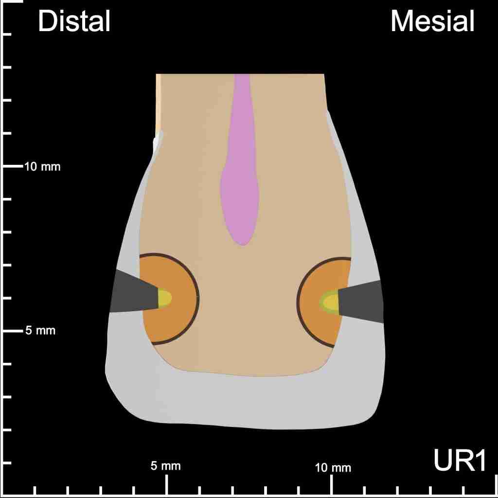 UR1 Mesial and Distal Mesiodistal Cutaway