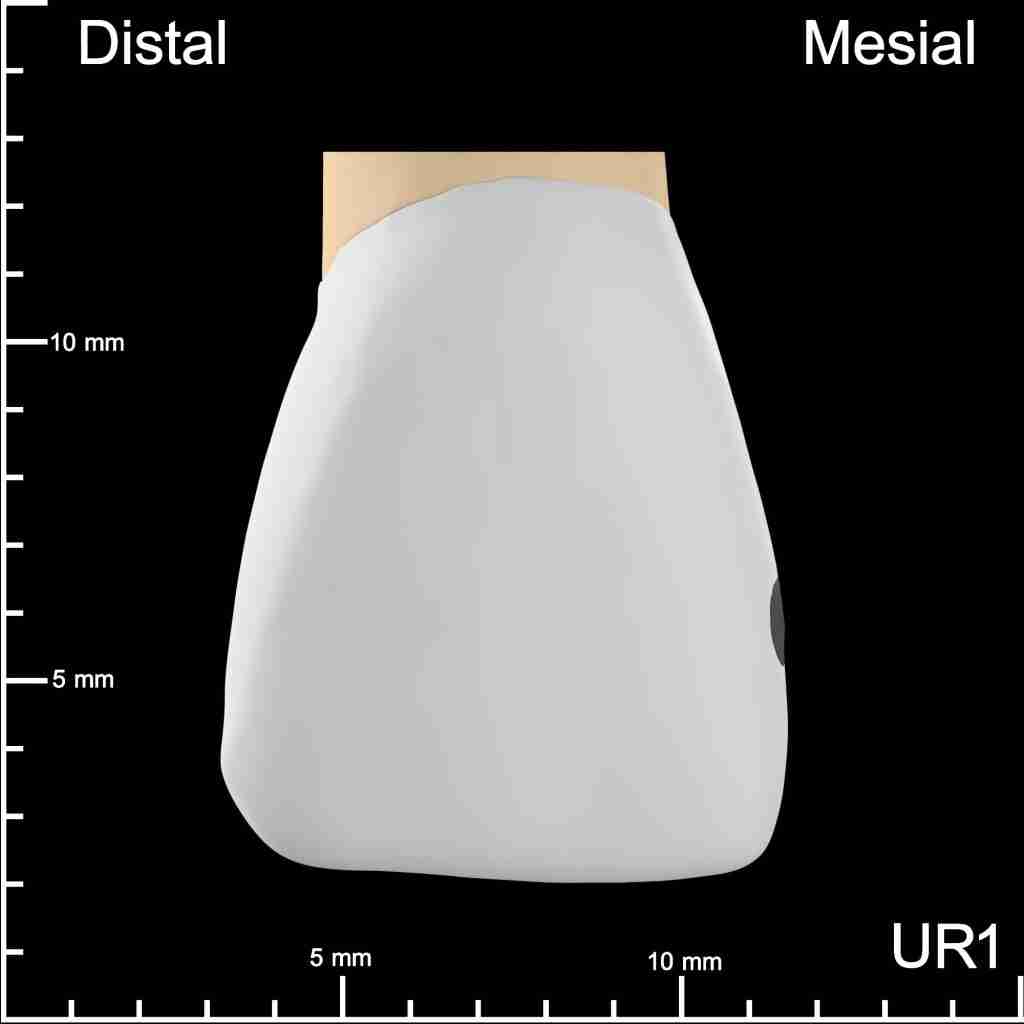UR1 Mesial Mesiodistal