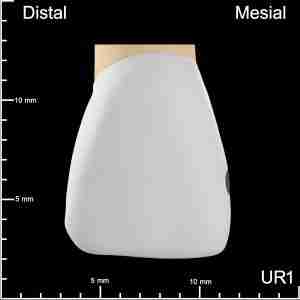 UR1 Mesial Mesiodistal