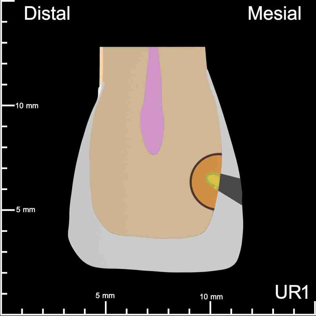 UR1 Mesial Mesiodistal Cutaway