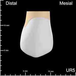 UR5 Mesial, Occlusal and Distal Mesiodistal
